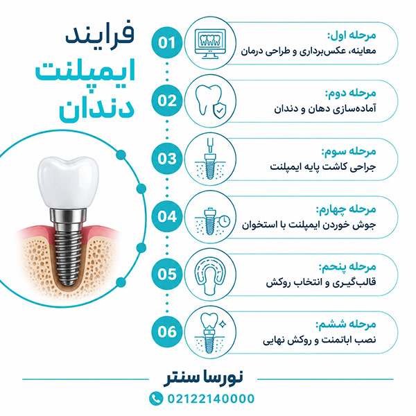 مراحل ایمپلنت دندان