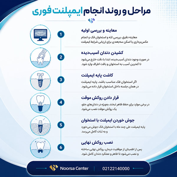 مراحل انجام ایمپلنت فوری