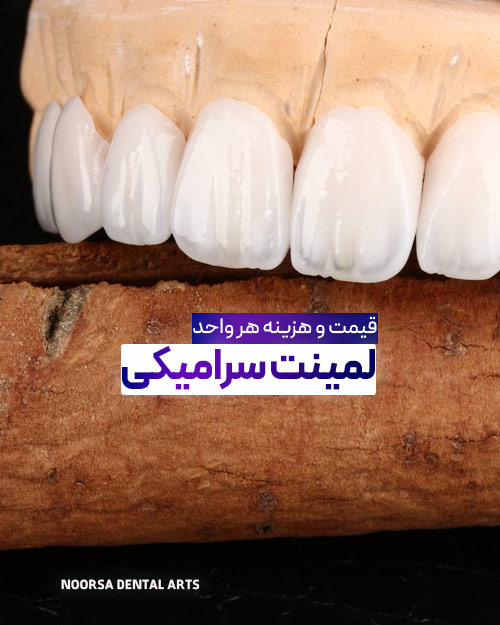 هزینه لمینت سرامیکی اقساطی