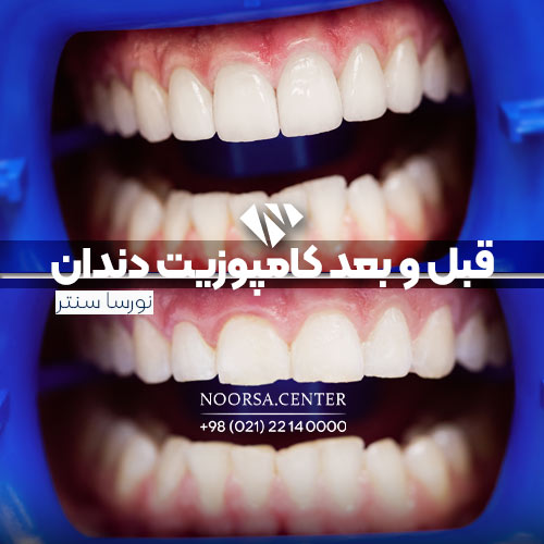 قبل و بعد کامپوزیت دندان در کلینیک نورسا