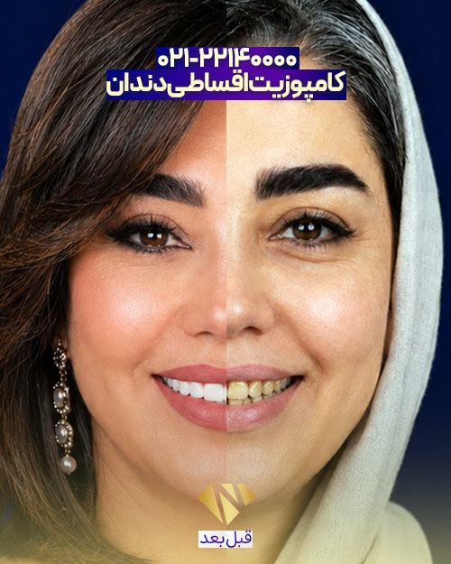 قبل و بعد کامپوزیت دندان