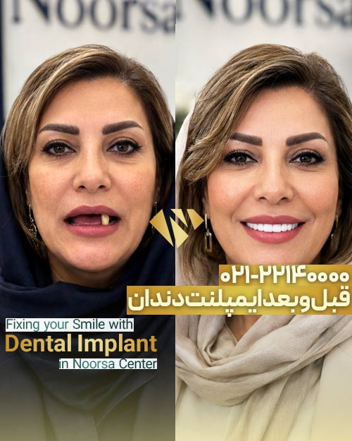 قبل و بعد ایمپلنت دندان