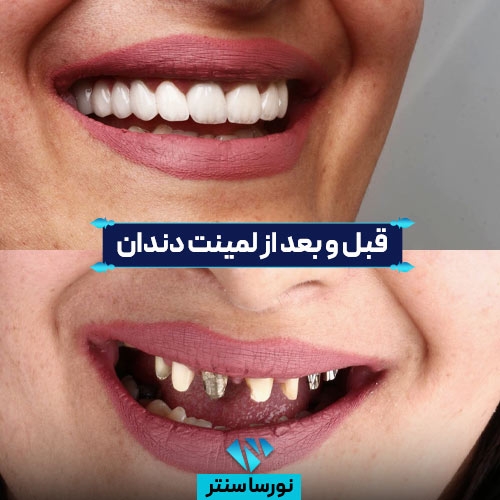 قبل و بعد لمینت دندان