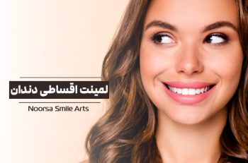 لمینت اقساطی دندان