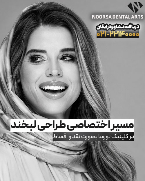 طراحی لبخند با لمینت دندان بصورت اقساطی در نورسا سنتر
