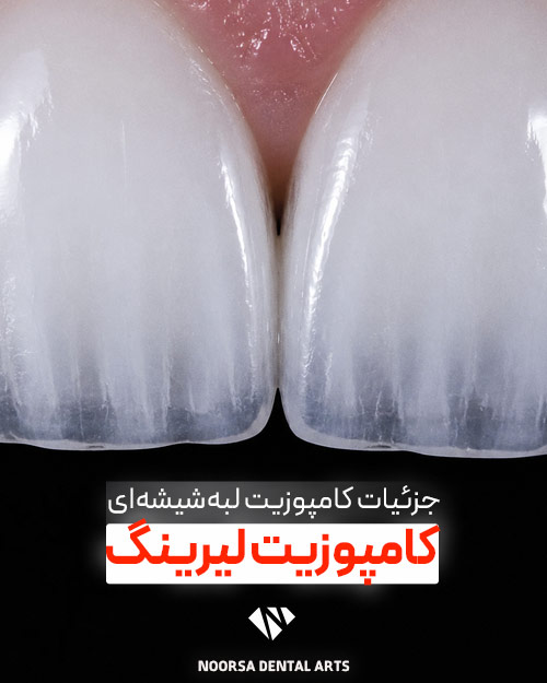 جزئیات کامپوزیت لیرینگ
