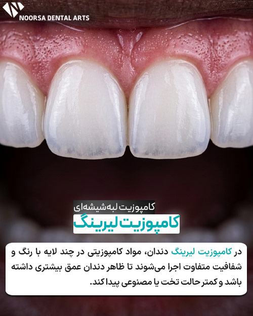 کامپوزیت لیرینگ دندان