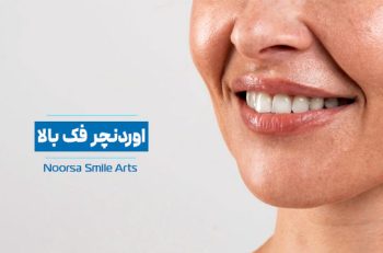 اوردنچر فک بالا