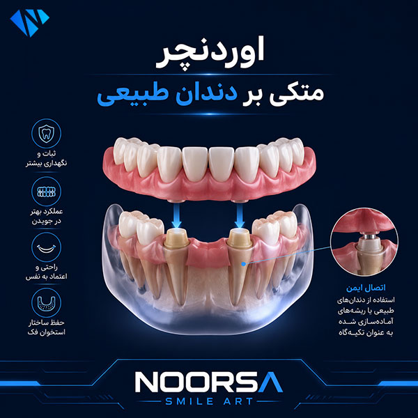 اوردنچر متکی بر دندان طبیعی