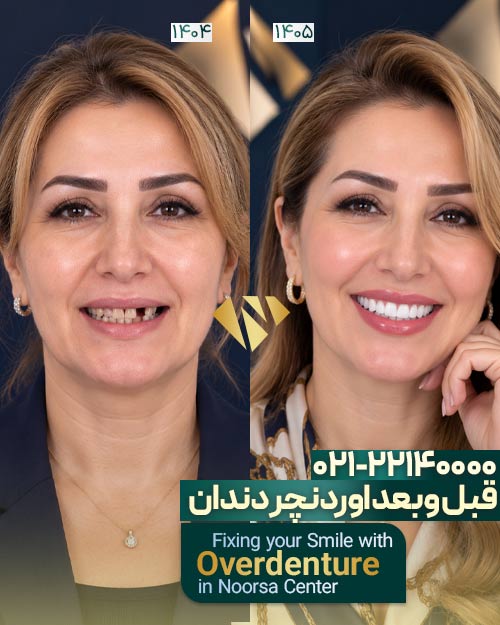 قبل و بعد اوردنچر دندان
