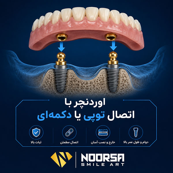 اوردنچر با اتصال توپی یا دکمه‌ای