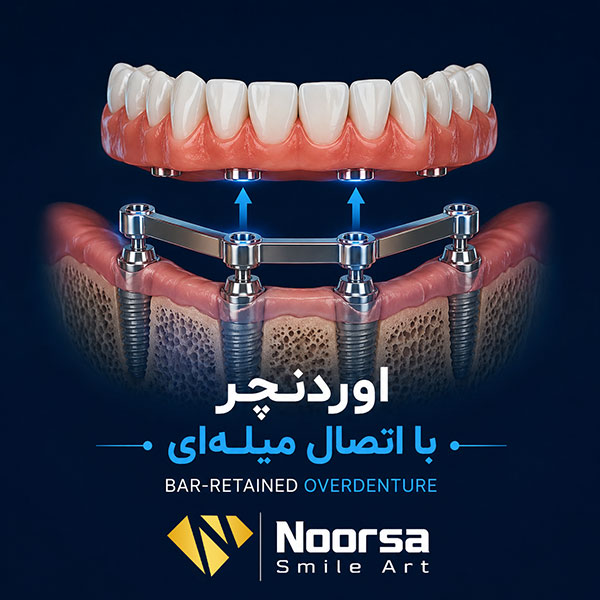 اوردنچر با اتصال میله‌ای