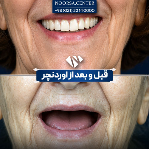 قبل و بعد اوردنچر در کلینیک نورسا