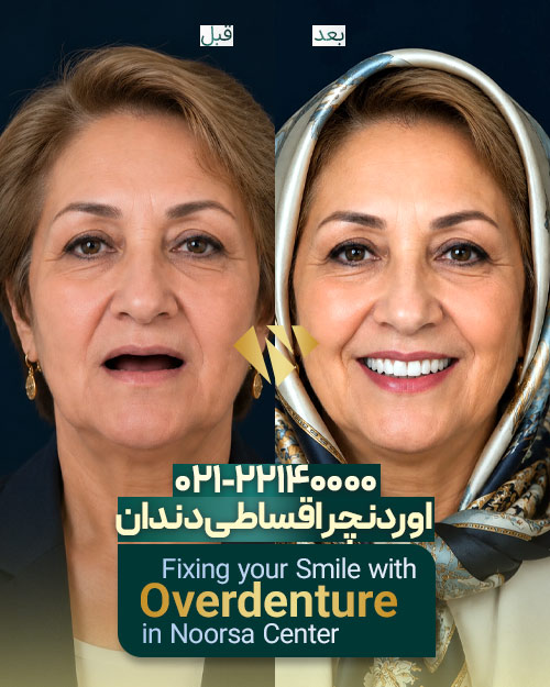 قبل و بعد اوردنچر دندان