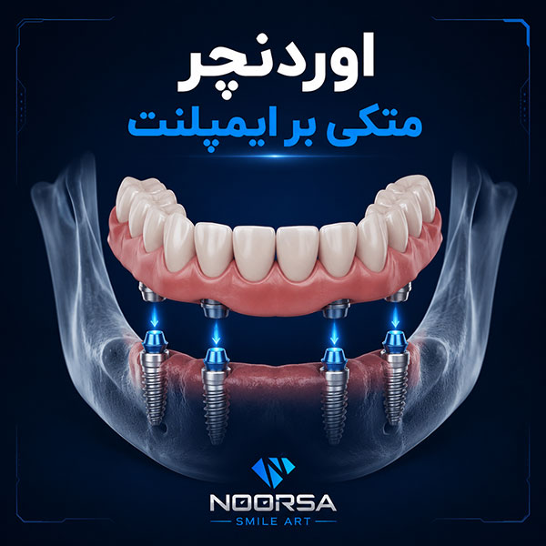 اوردنچر متکی بر ایمپلنت