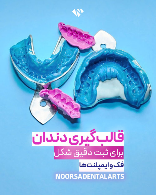 قالب گیری دندان برای اوردنچر