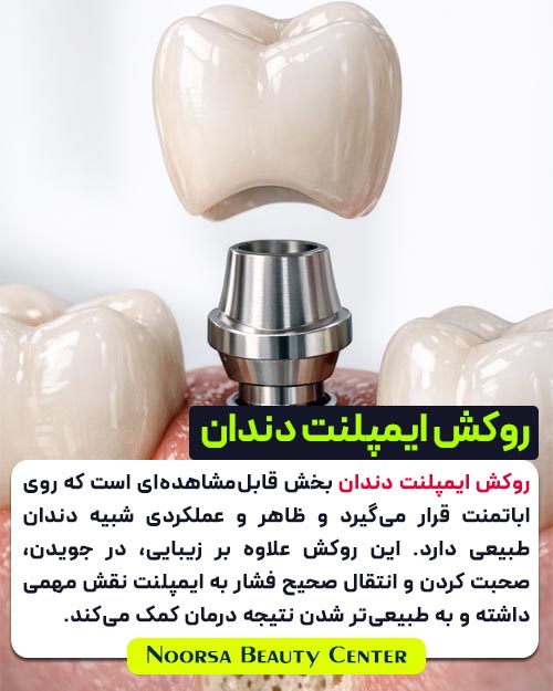 روکش ایمپلنت دندان