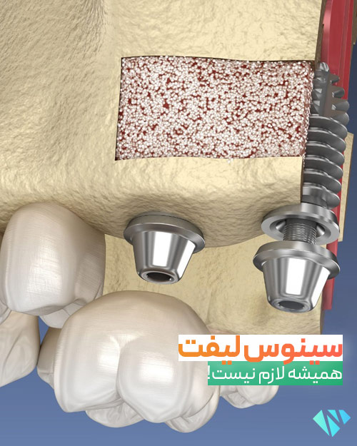 الزام سینوس لیفت برای ایمپلنت دندان