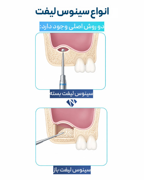 انواع سینوس لیفت