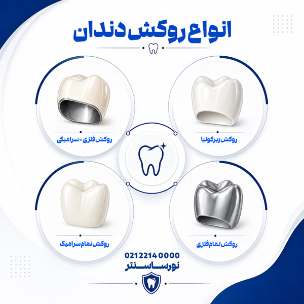 انواع روکش دندان