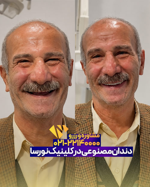 قبل و بعد دندان مصنوعی در کلینیک نورسا