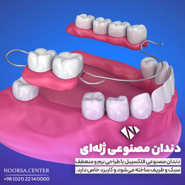دندان دست فلکسیبل چیست