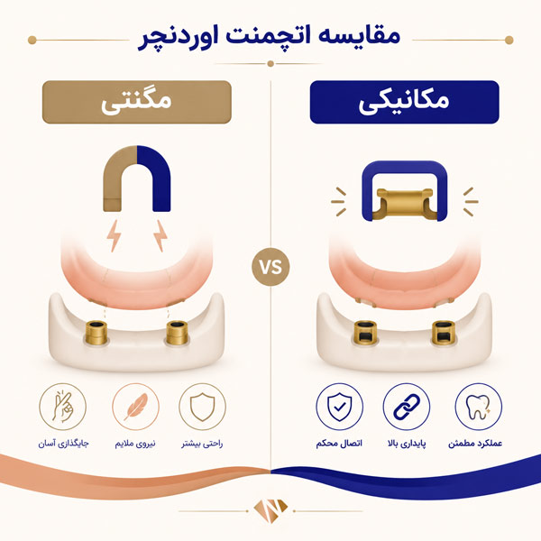 مقایسه اتچمنت اوردنچر مکانیکی و مگنتی