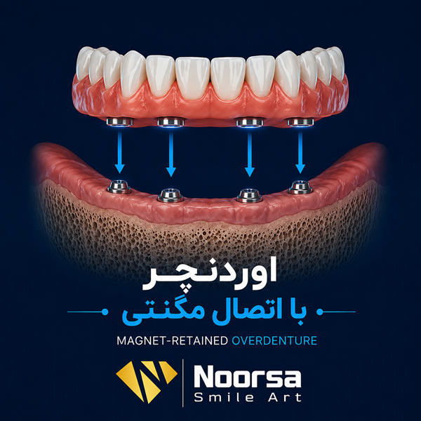 اوردنچر مگنتی (آهنربایی)