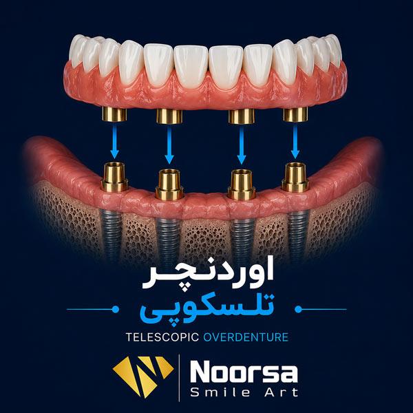 اوردنچر تلسکوپی