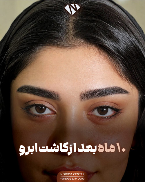 10 ماه بعد از کاشت ابروی طبیعی