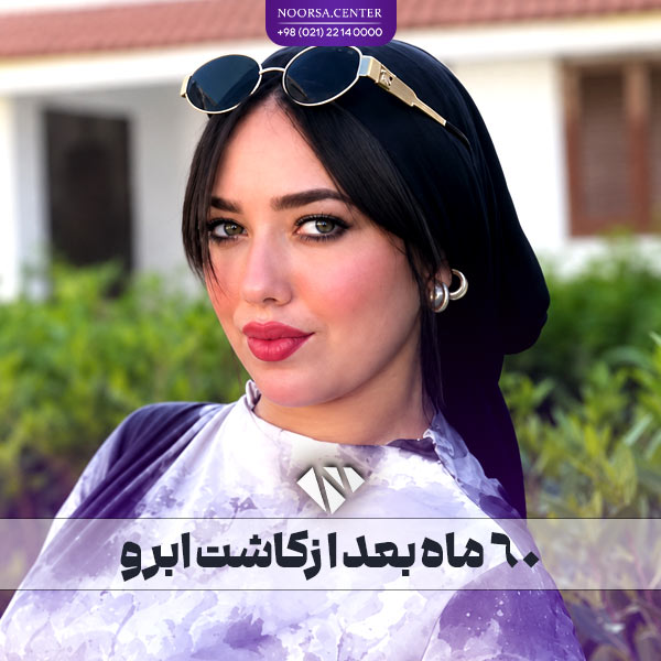 60 ماه (چندسال) بعد از کاشت ابرو