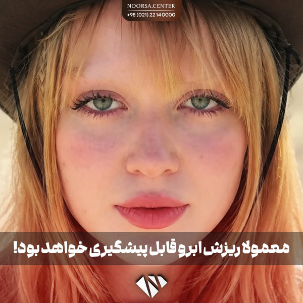 پیشگیری از ریزش ابرو
