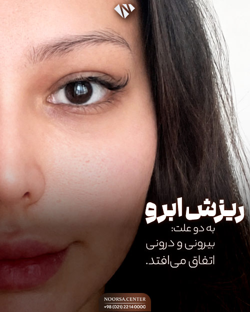 علت های ریزش ابرو