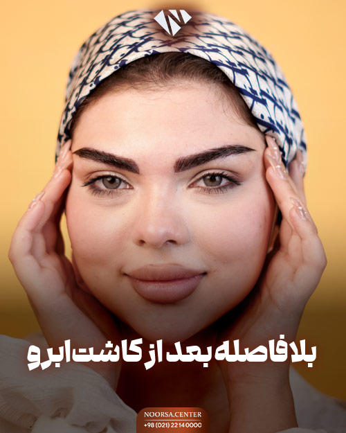 بلافاصله بعد از کاشت ابرو