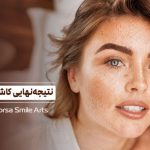 مشخص شدن نتیجه کاشت ابرو