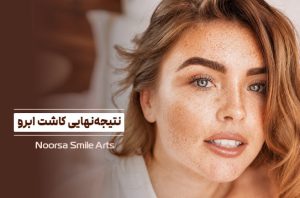 مشخص شدن نتیجه کاشت ابرو