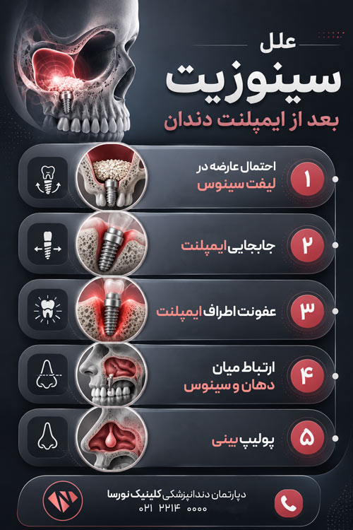 دلایل سینوزیت بعد از ایمپلنت دندان