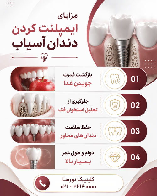 مزایای ایملپنت دندان آسیاب