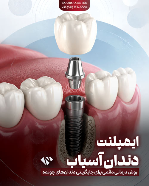 ایمپلنت دندان آسیاب چیست