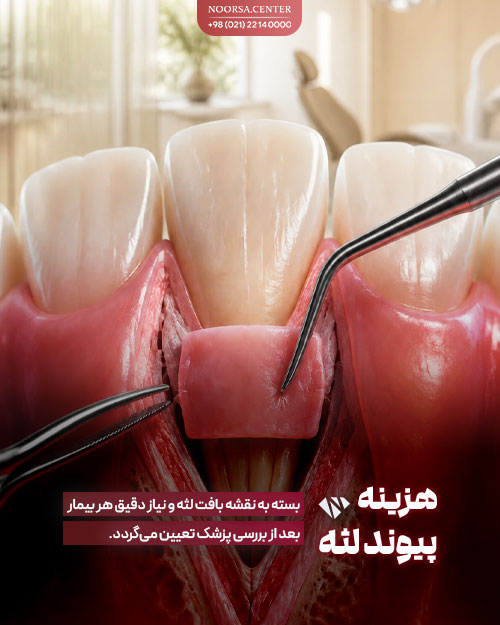 هزینه پیوند لثه چقدر است