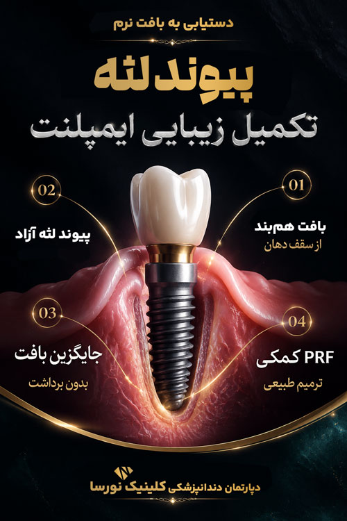 روش های پیوند لثه برای ایمپلنت