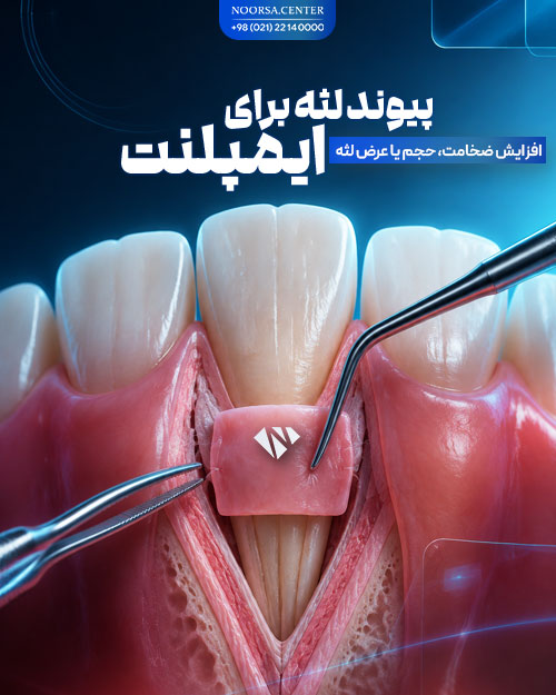 پیوند لثه برای ایمپلنت دندان