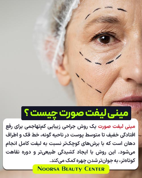مینی لیفت صورت